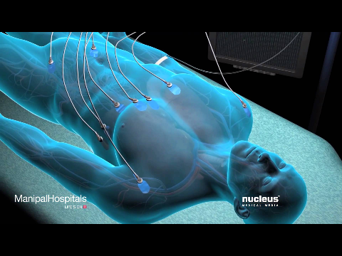 General Anesthesia | Effect of  Anesthesia | Delivery of General anaesthesia | Manipal Hospitals