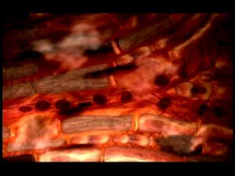 What happens during a Heart Attack?