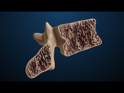 Osteoporosis