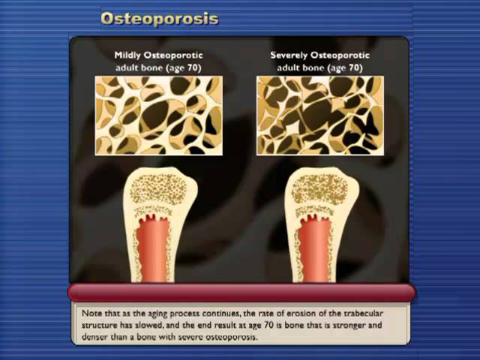 What is Osteoporosis and How to prevent it