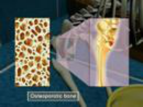 Osteoporosis-3D Medical Animation